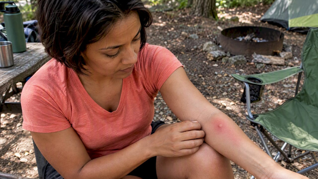Camper examines a bite on sunburned skin