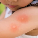 What is the Best Mosquito Repellent Without Chemicals? 3 Best Mosquito Repellent Without Chemicals